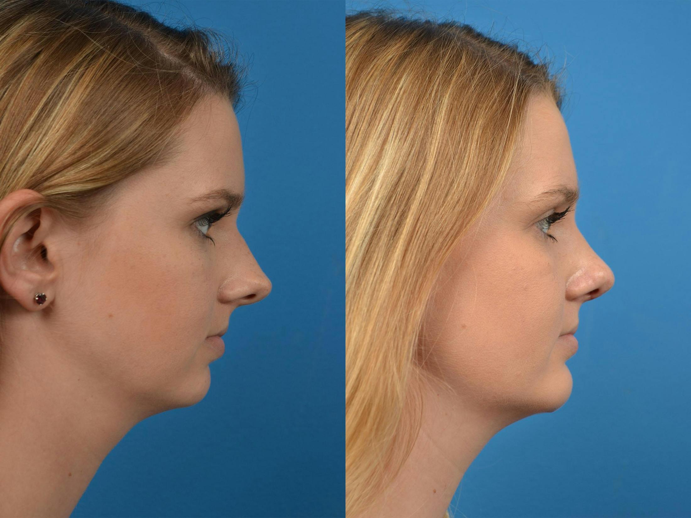 Rhinoplasty Before & After Gallery - Patient 122406891 - Image 3