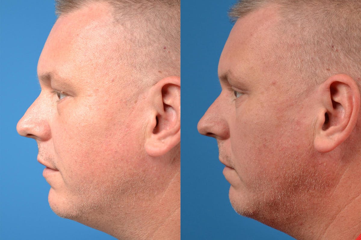 Skin Resurfacing Before & After Gallery - Patient 122406892 - Image 5