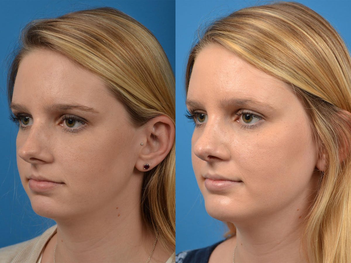 Rhinoplasty Before & After Gallery - Patient 122406891 - Image 4