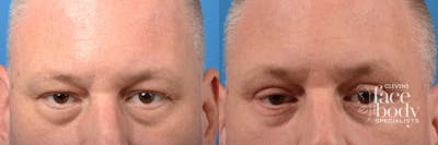 Eyelid Surgery Before & After Gallery - Patient 228965 - Image 1
