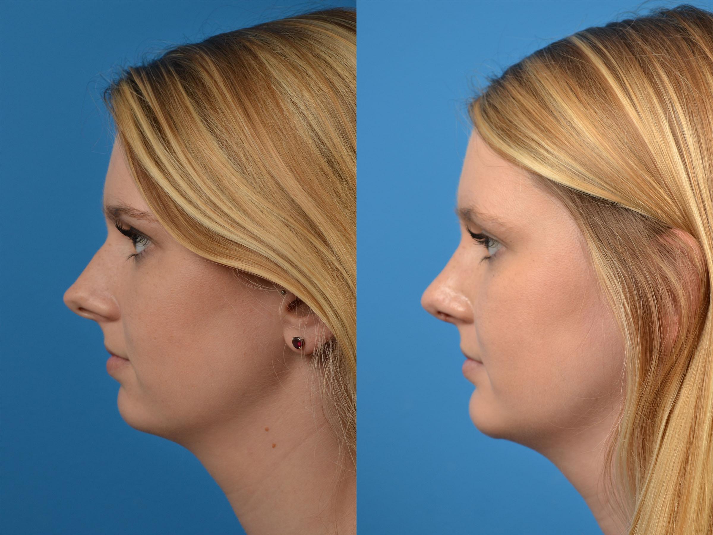 Rhinoplasty Before & After Gallery - Patient 122406891 - Image 5