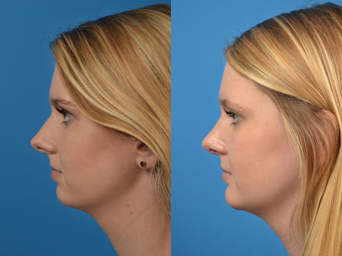 Rhinoplasty Before & After Gallery - Patient 122406891 - Image 5