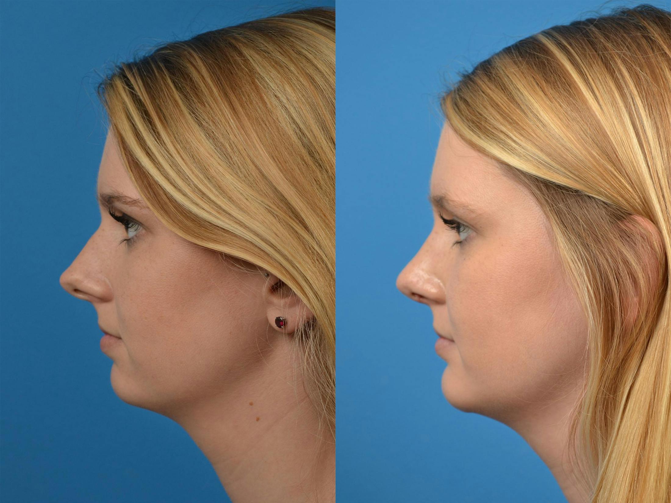 Rhinoplasty Before & After Gallery - Patient 122406891 - Image 5
