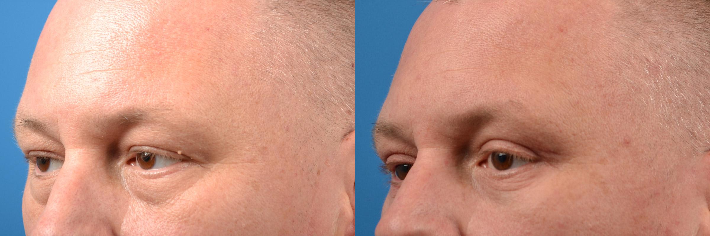 Eyelid Surgery Before & After Gallery - Patient 228965 - Image 4