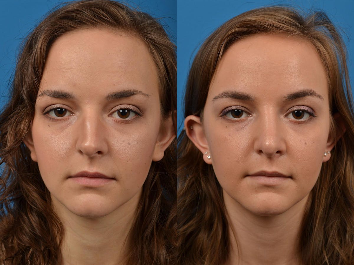 Rhinoplasty Before & After Gallery - Patient 122406893 - Image 1