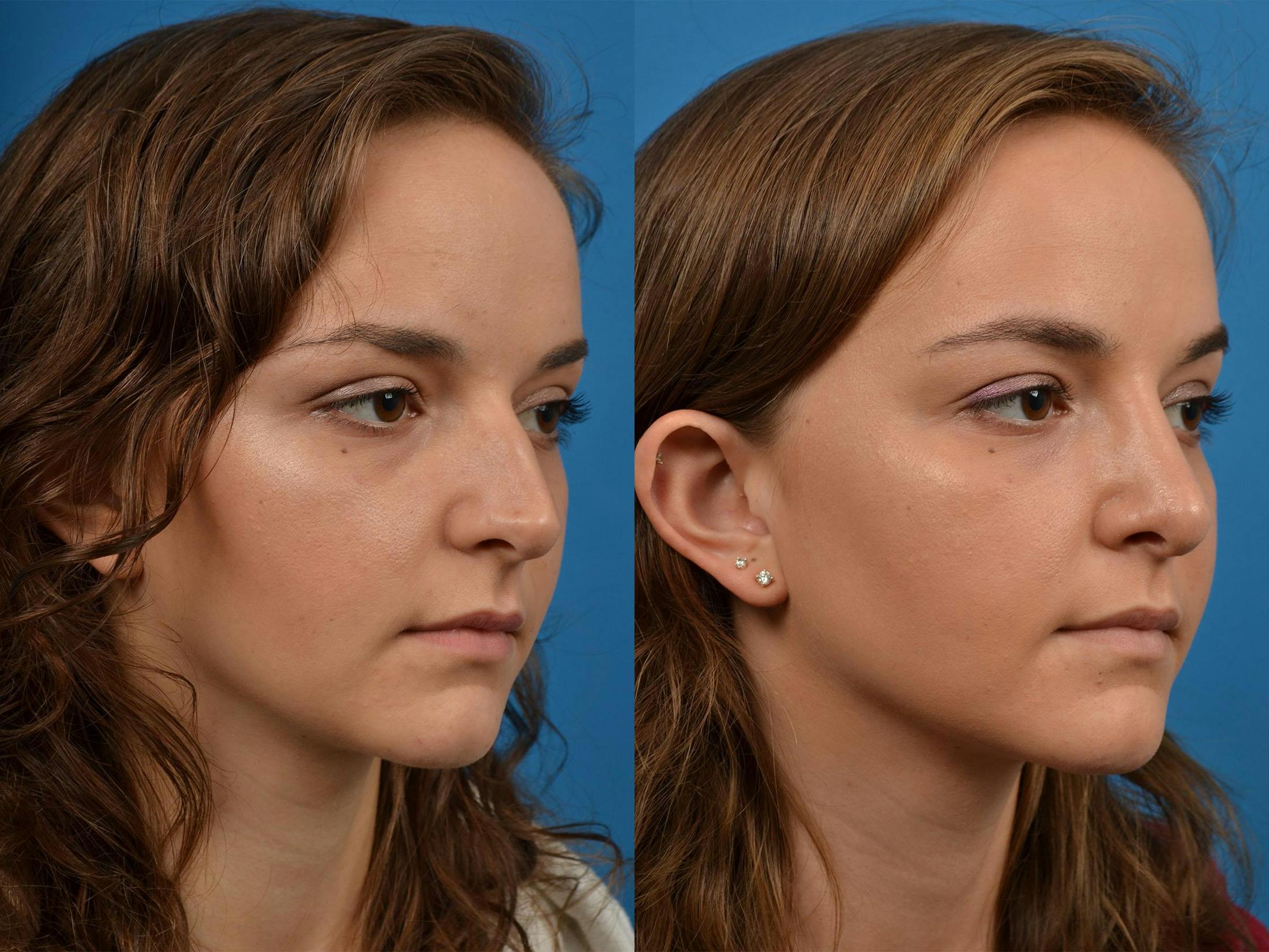 Rhinoplasty Before & After Gallery - Patient 122406893 - Image 2