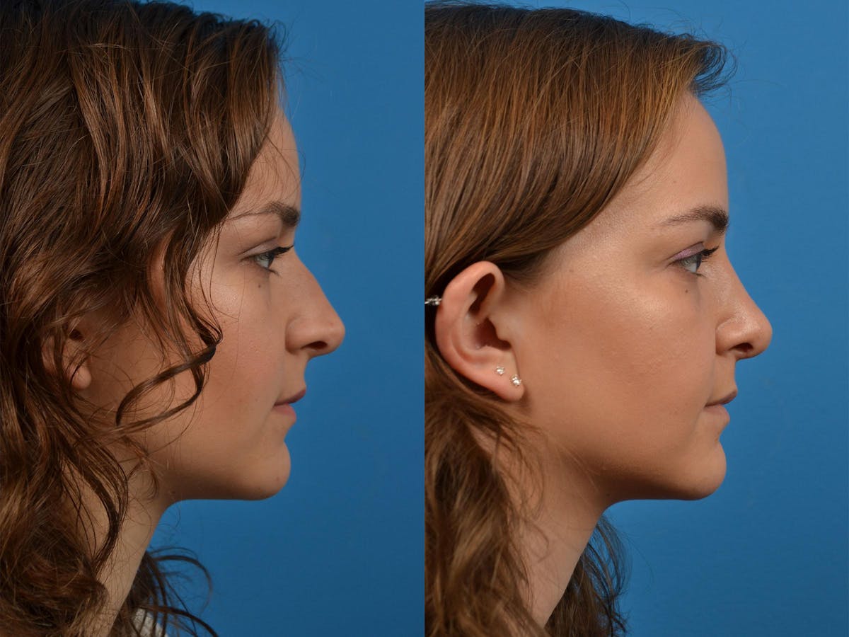 Rhinoplasty Before & After Gallery - Patient 122406893 - Image 3
