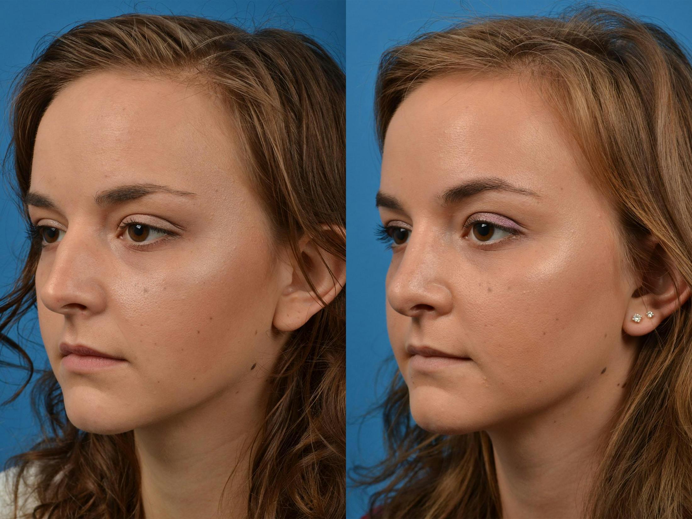 Rhinoplasty Before & After Gallery - Patient 122406893 - Image 4