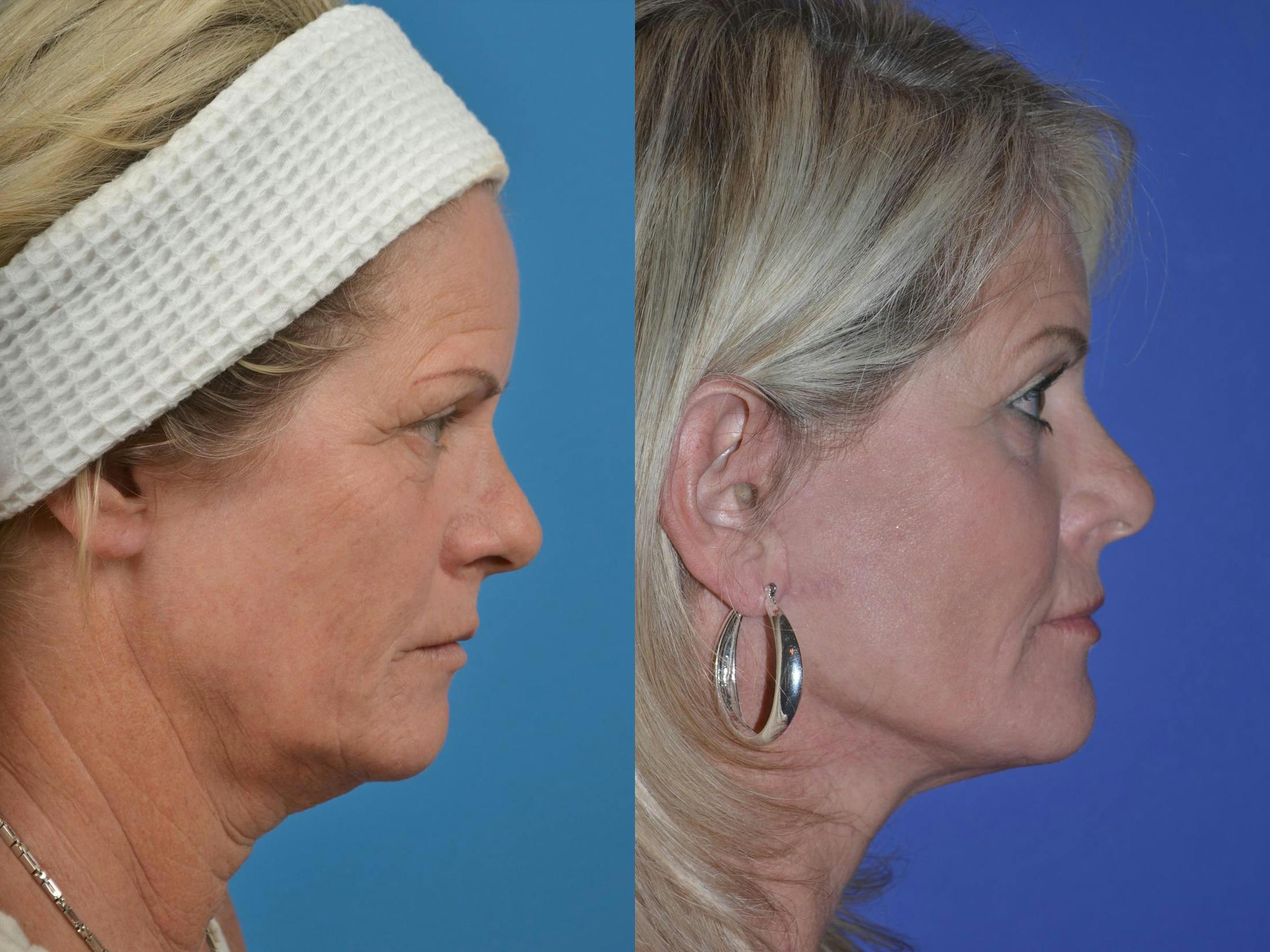 Skin Resurfacing Before & After Gallery - Patient 122406894 - Image 3