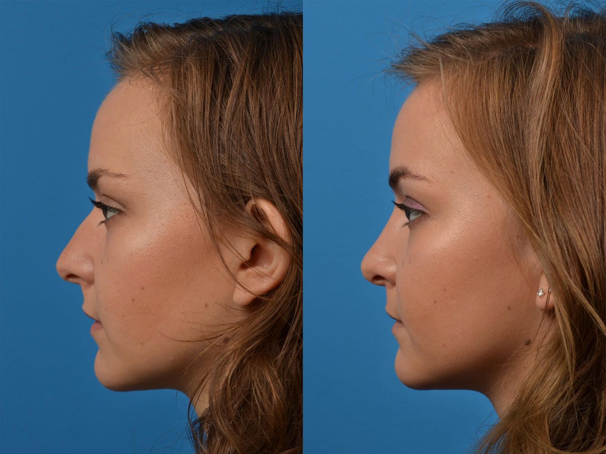 Rhinoplasty Before & After Gallery - Patient 122406893 - Image 5