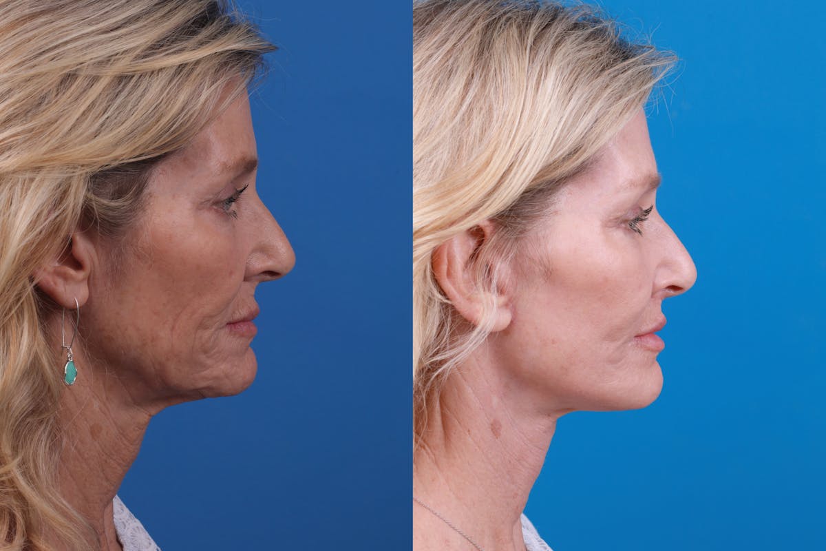 Lip Lift Before & After Gallery - Patient 122406908 - Image 3