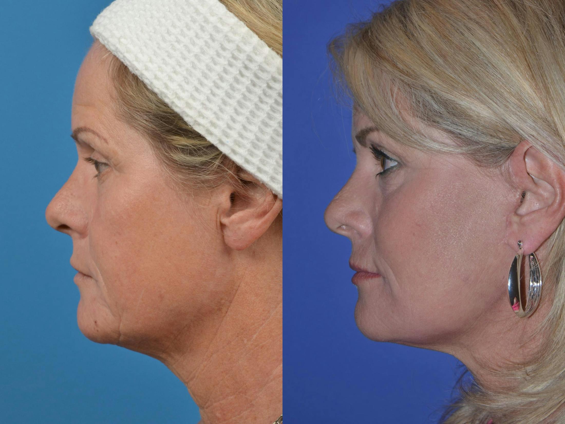 Skin Resurfacing Before & After Gallery - Patient 122406894 - Image 5