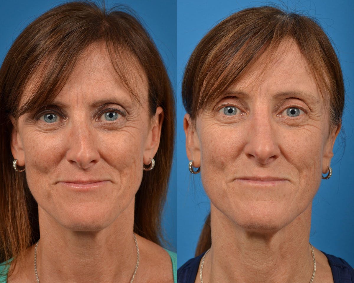 Rhinoplasty Before & After Gallery - Patient 122406910 - Image 1