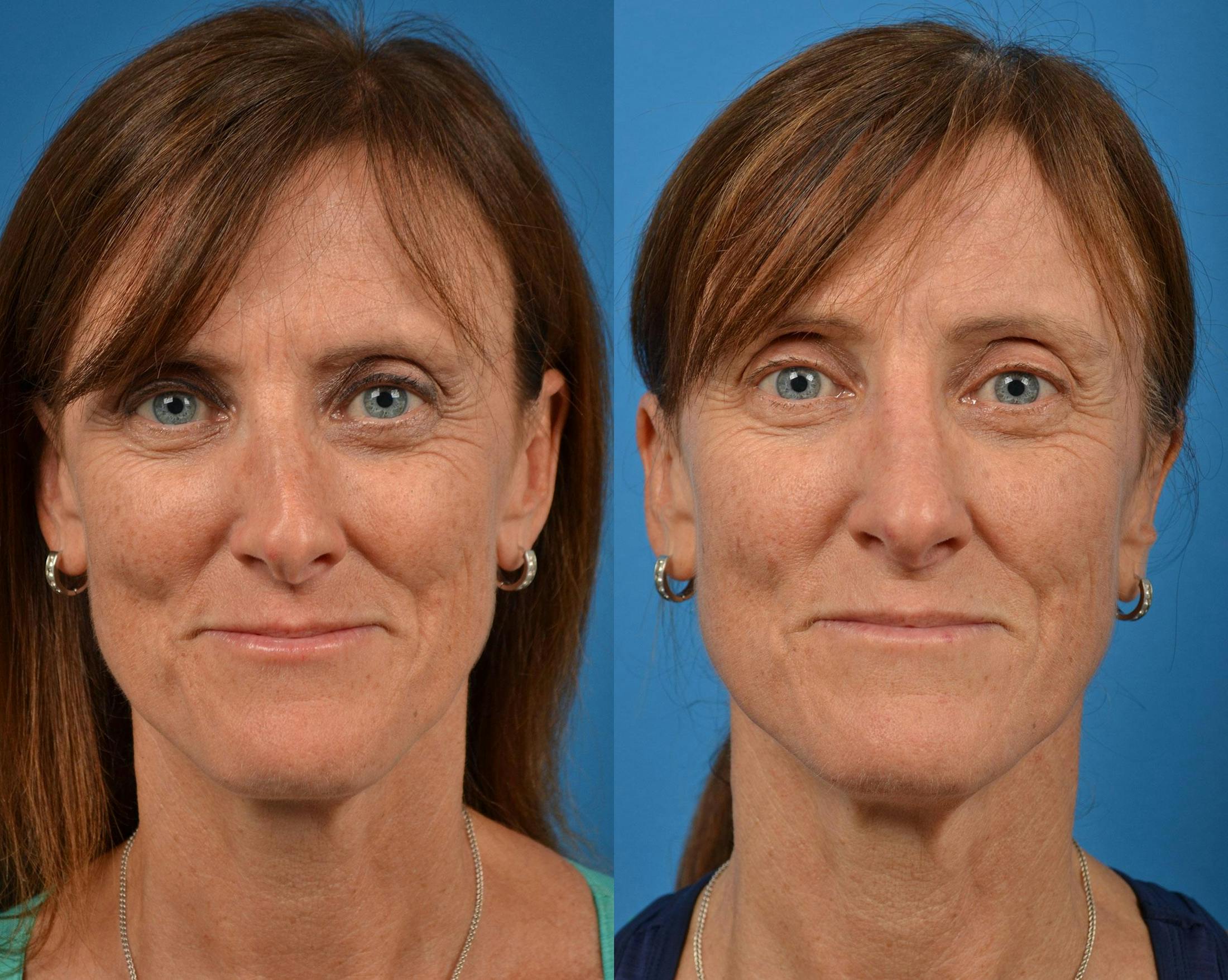 Rhinoplasty Before & After Gallery - Patient 122406910 - Image 1