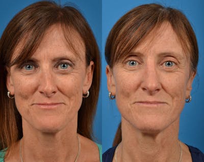 Rhinoplasty Before & After Gallery - Patient 122406910 - Image 1