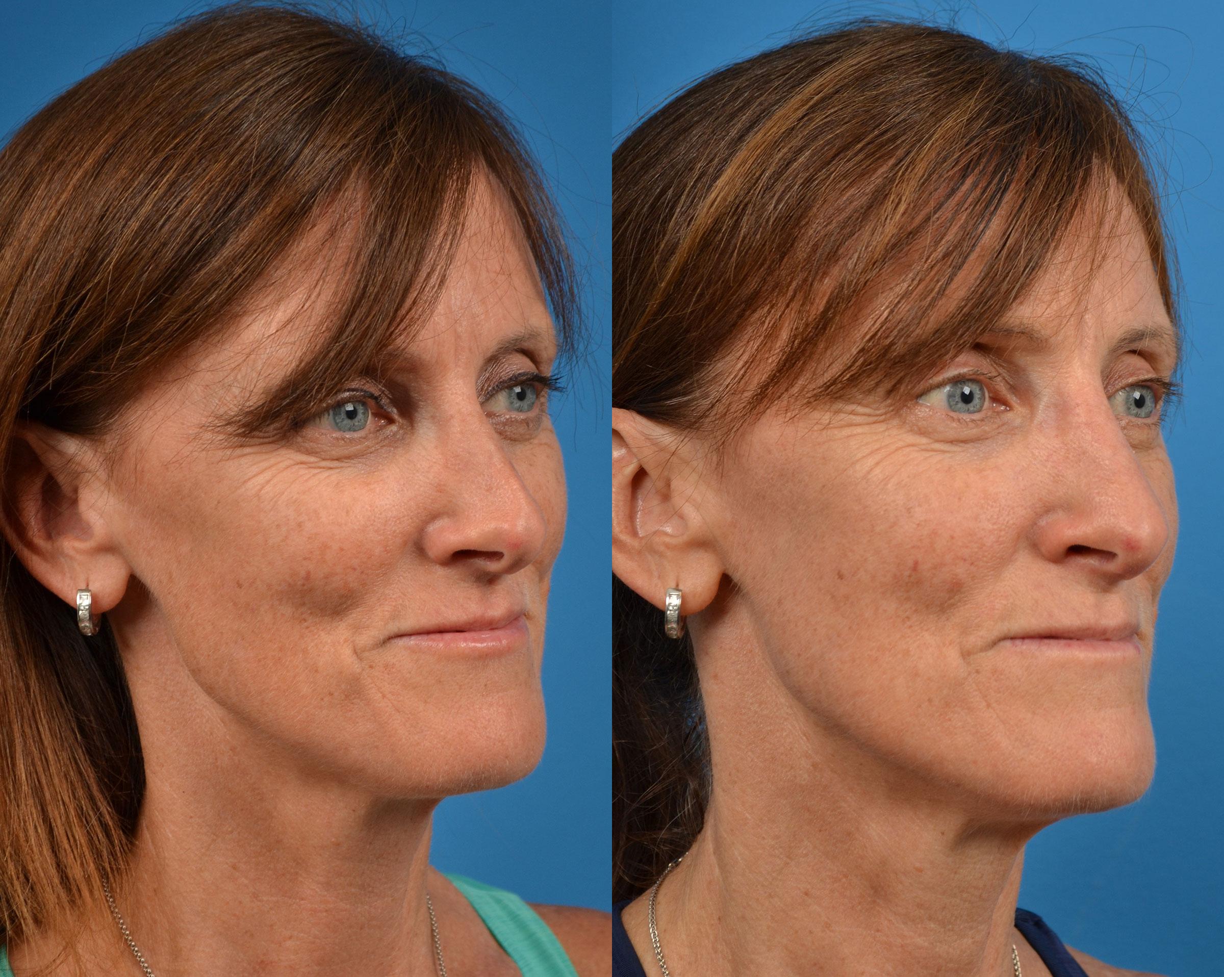 Rhinoplasty Before & After Gallery - Patient 122406910 - Image 2