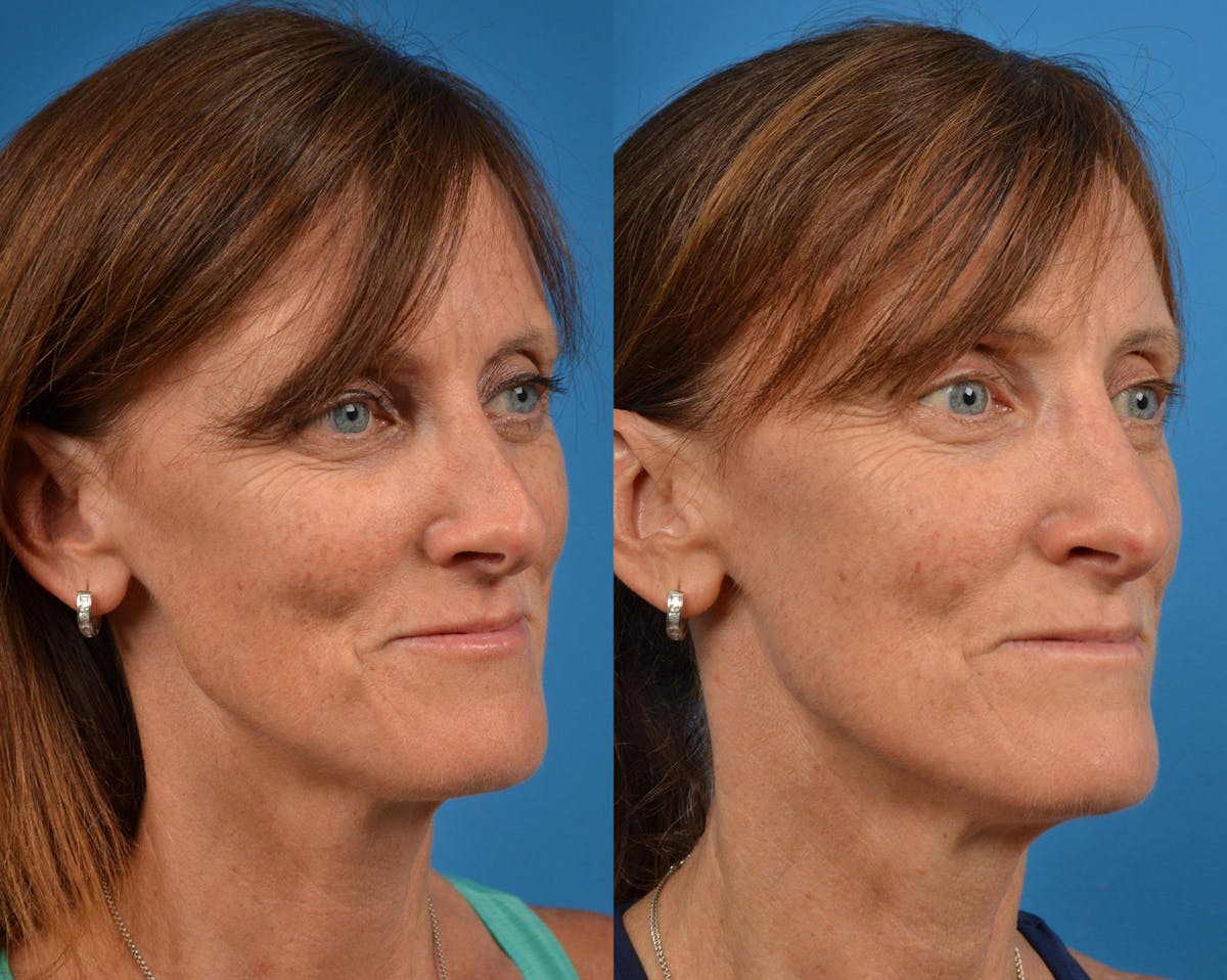 Rhinoplasty Before & After Gallery - Patient 122406910 - Image 2