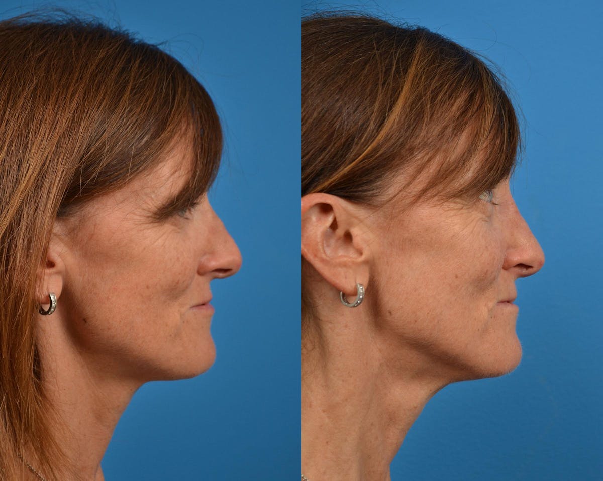 Rhinoplasty Before & After Gallery - Patient 122406910 - Image 3