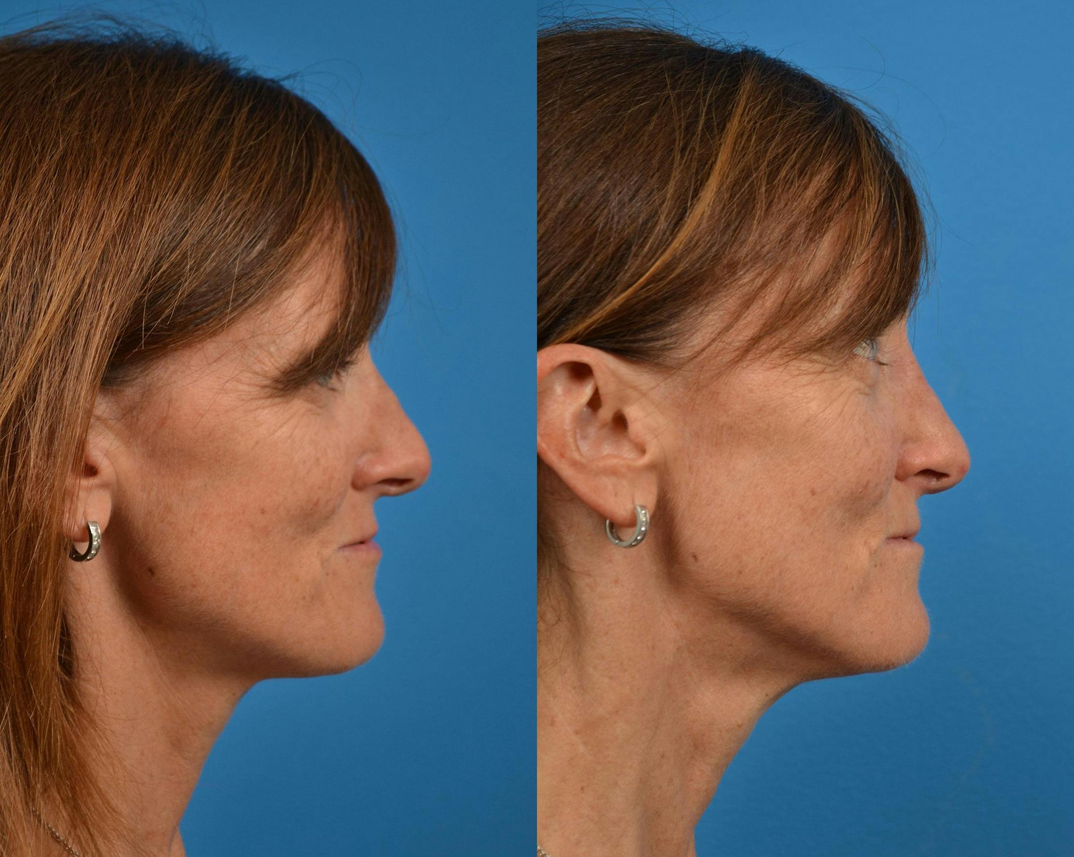 Rhinoplasty Before & After Gallery - Patient 122406910 - Image 3
