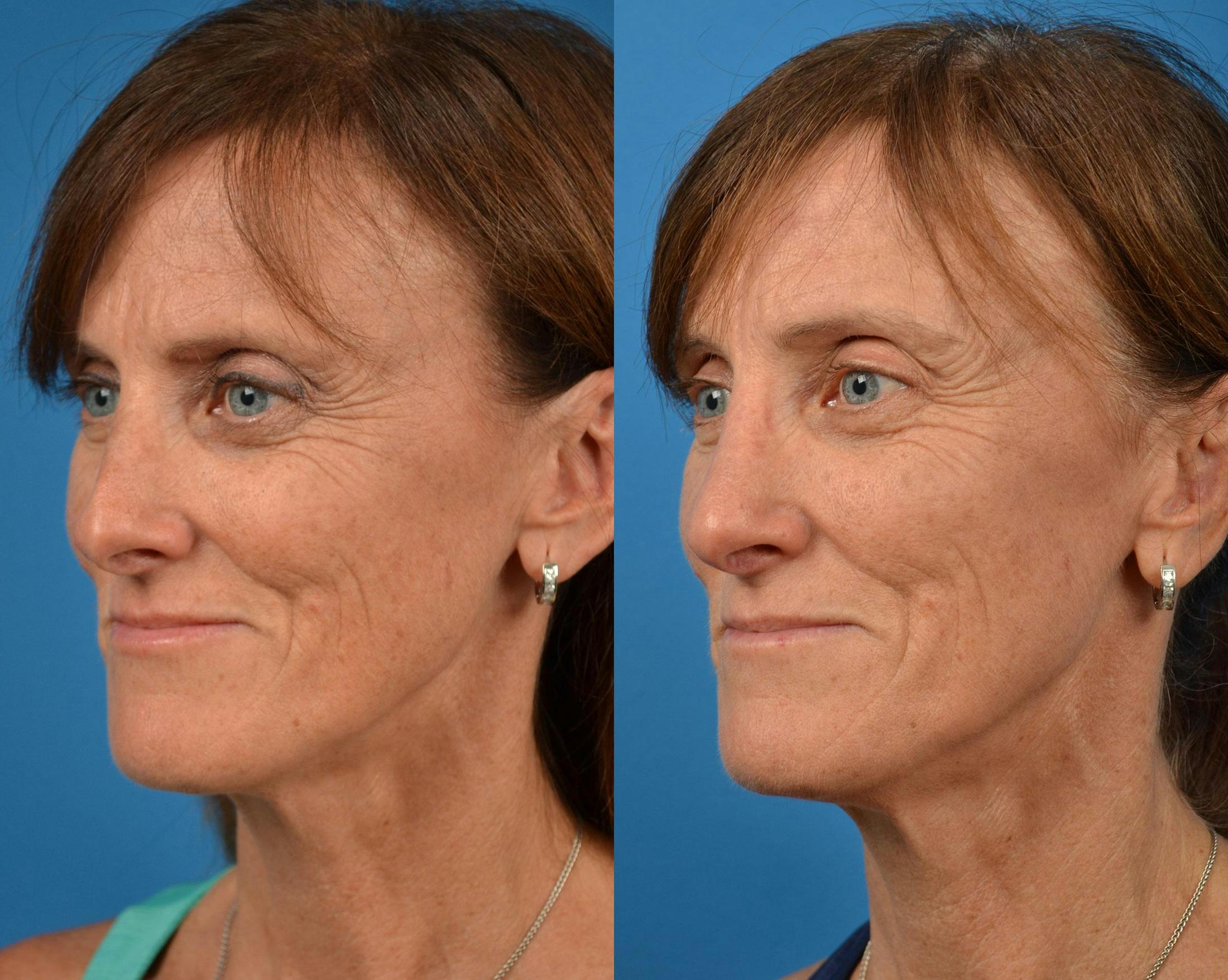 Rhinoplasty Before & After Gallery - Patient 122406910 - Image 4