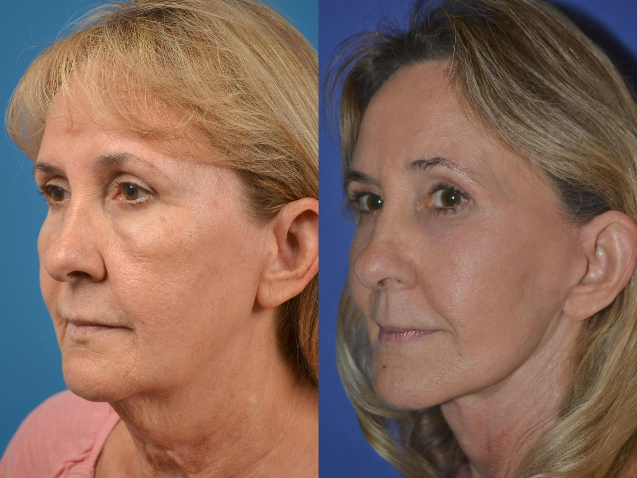 Skin Resurfacing Before & After Gallery - Patient 122406911 - Image 4