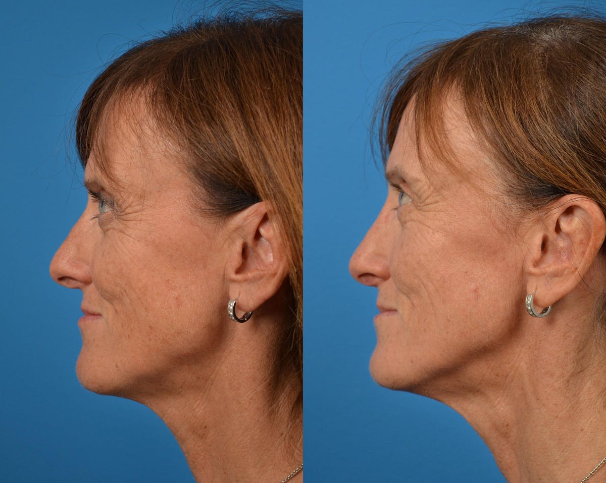 Rhinoplasty Before & After Gallery - Patient 122406910 - Image 5