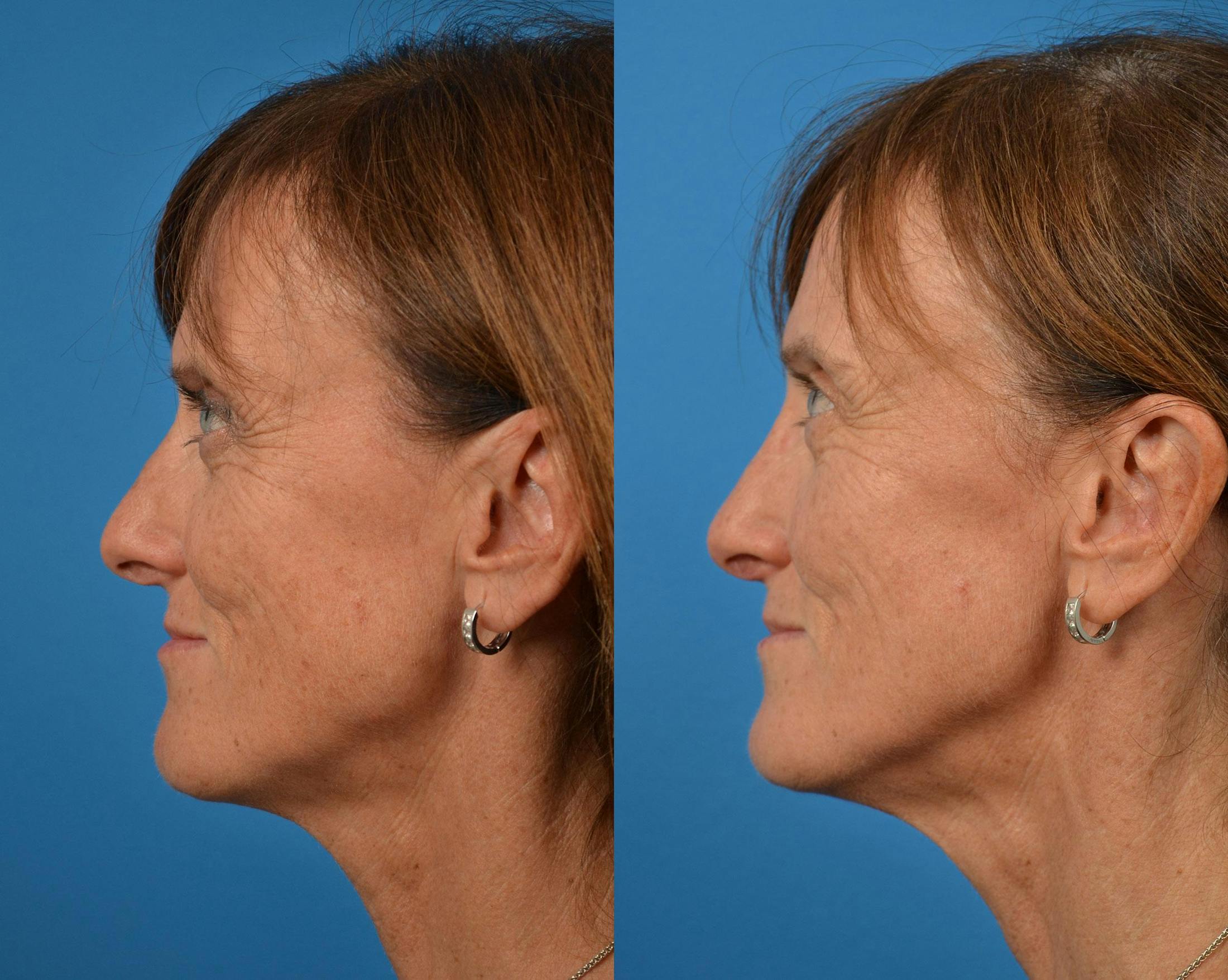 Rhinoplasty Before & After Gallery - Patient 122406910 - Image 5