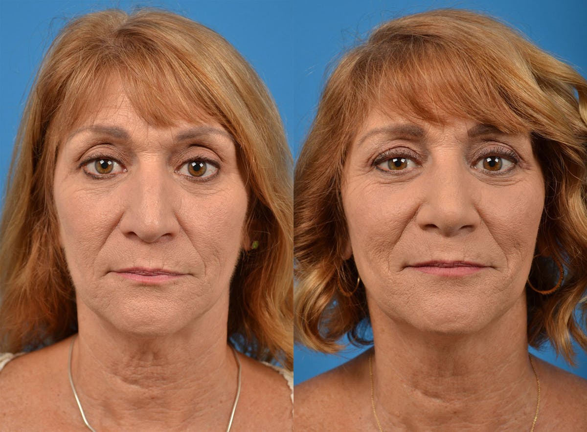 Rhinoplasty Before & After Gallery - Patient 122406912 - Image 1
