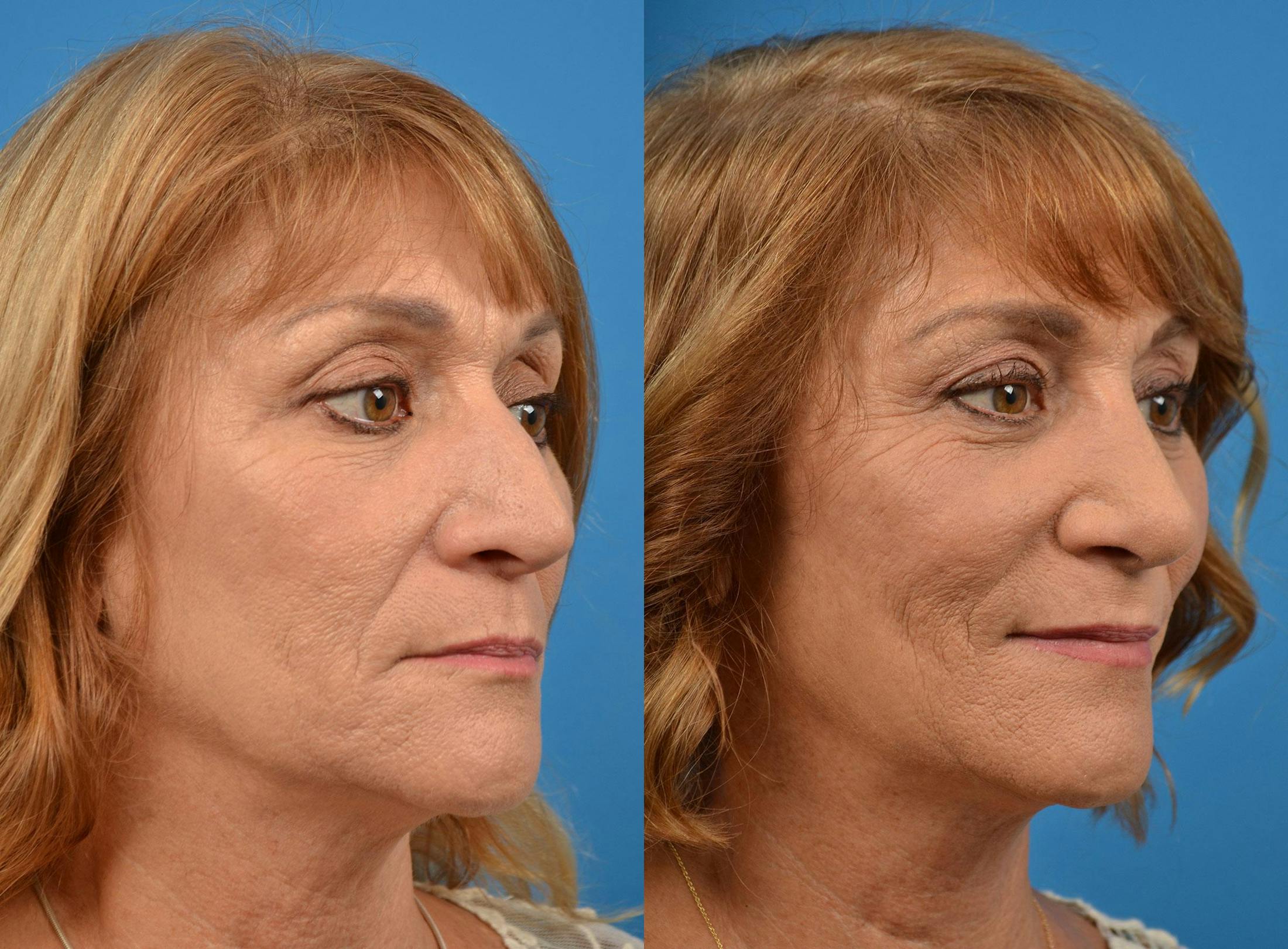 Rhinoplasty Before & After Gallery - Patient 122406912 - Image 2