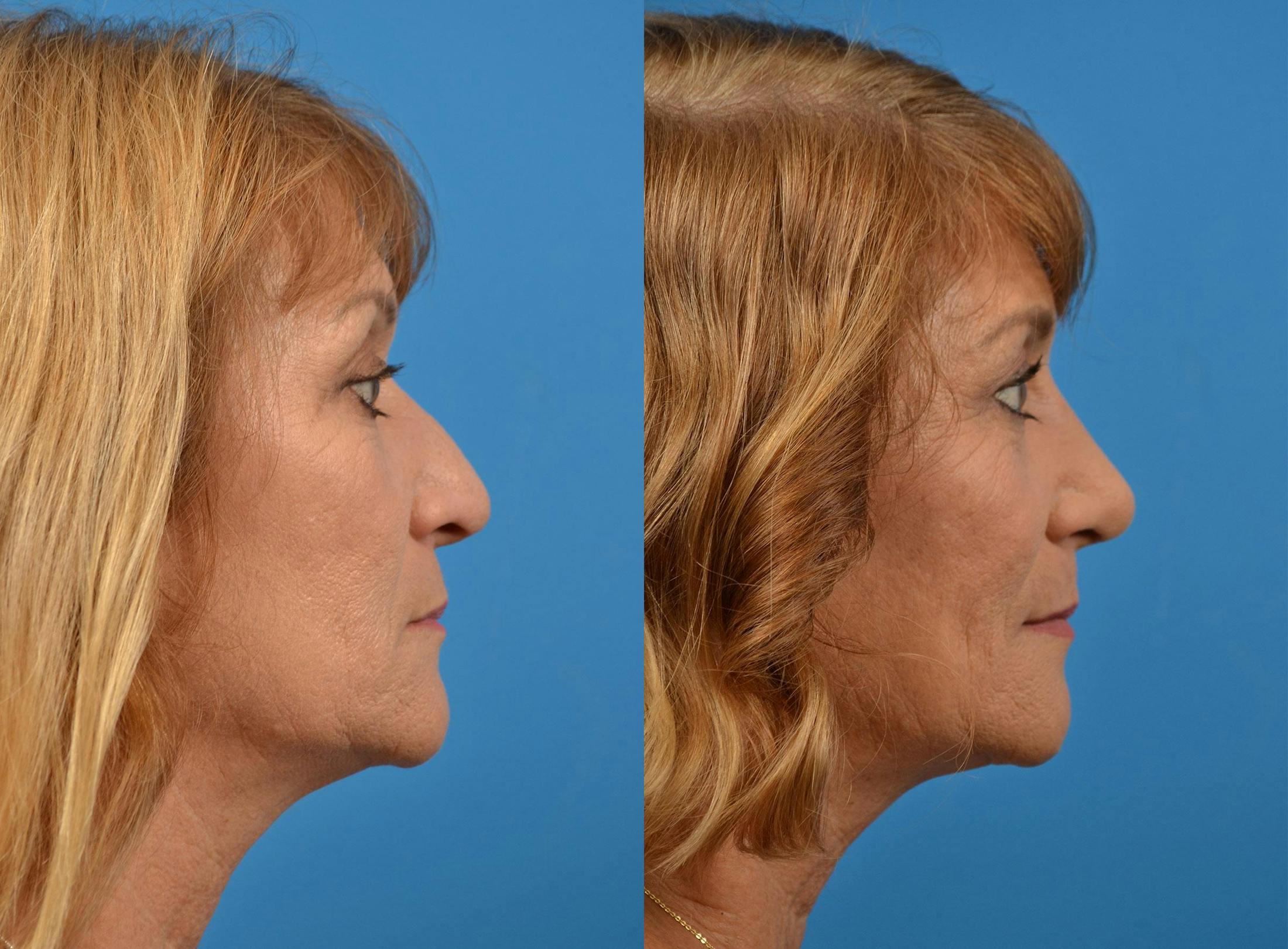 Rhinoplasty Before & After Gallery - Patient 122406912 - Image 3