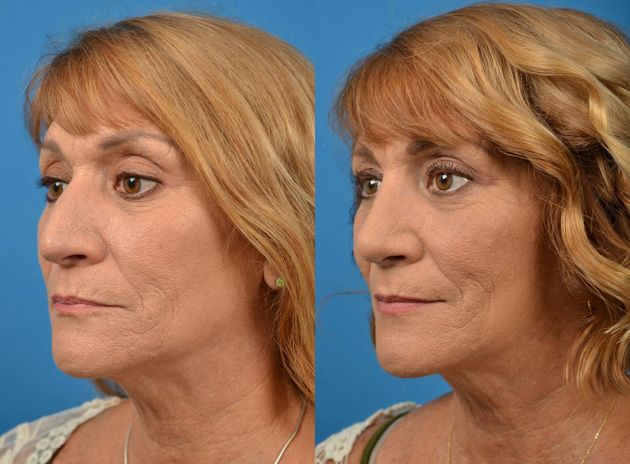 Rhinoplasty Before & After Gallery - Patient 122406912 - Image 4