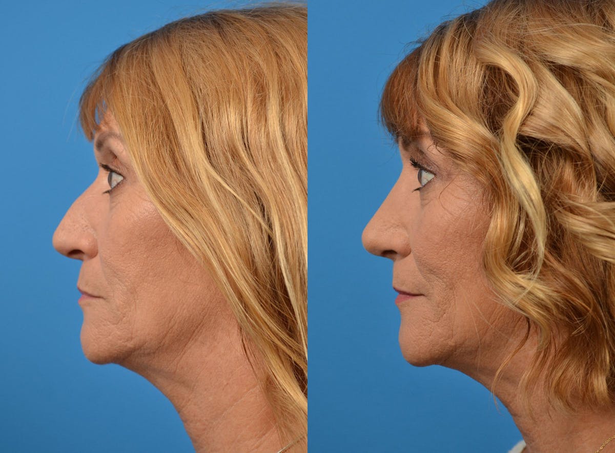 Rhinoplasty Before & After Gallery - Patient 122406912 - Image 5