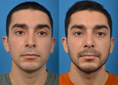 Rhinoplasty Before & After Gallery - Patient 122406921 - Image 1
