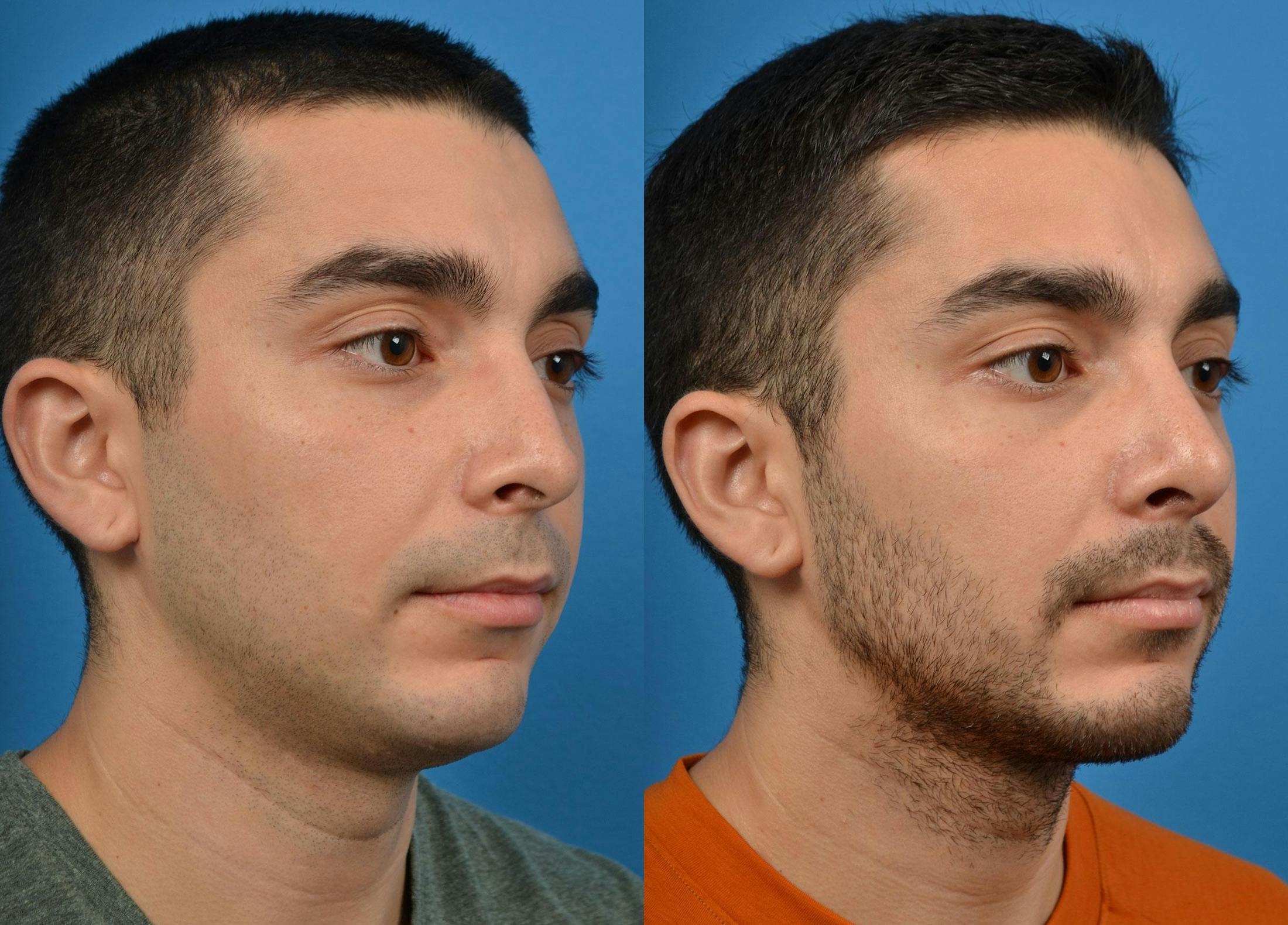 Rhinoplasty Before & After Gallery - Patient 122406921 - Image 2