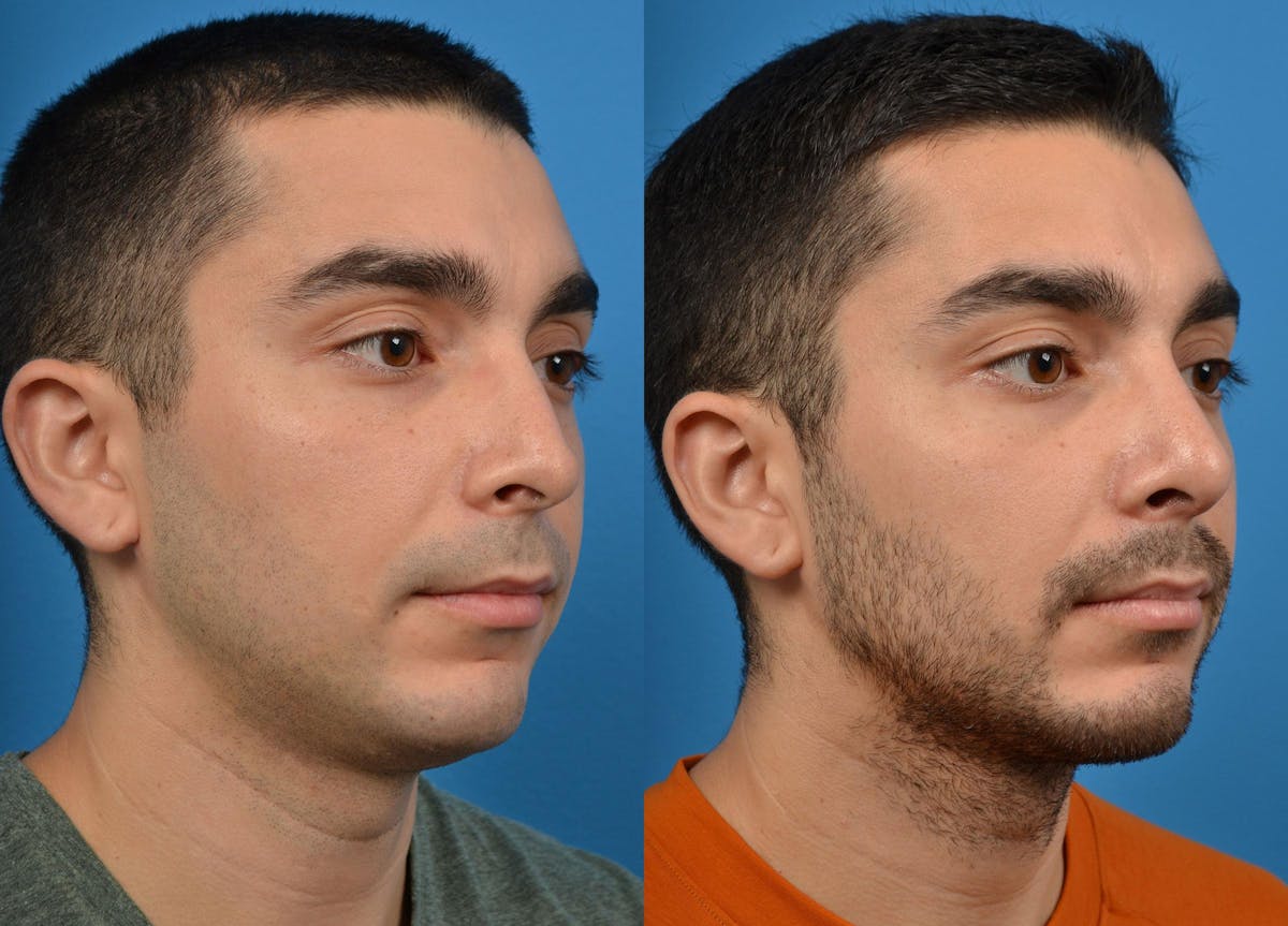Rhinoplasty Before & After Gallery - Patient 122406921 - Image 2