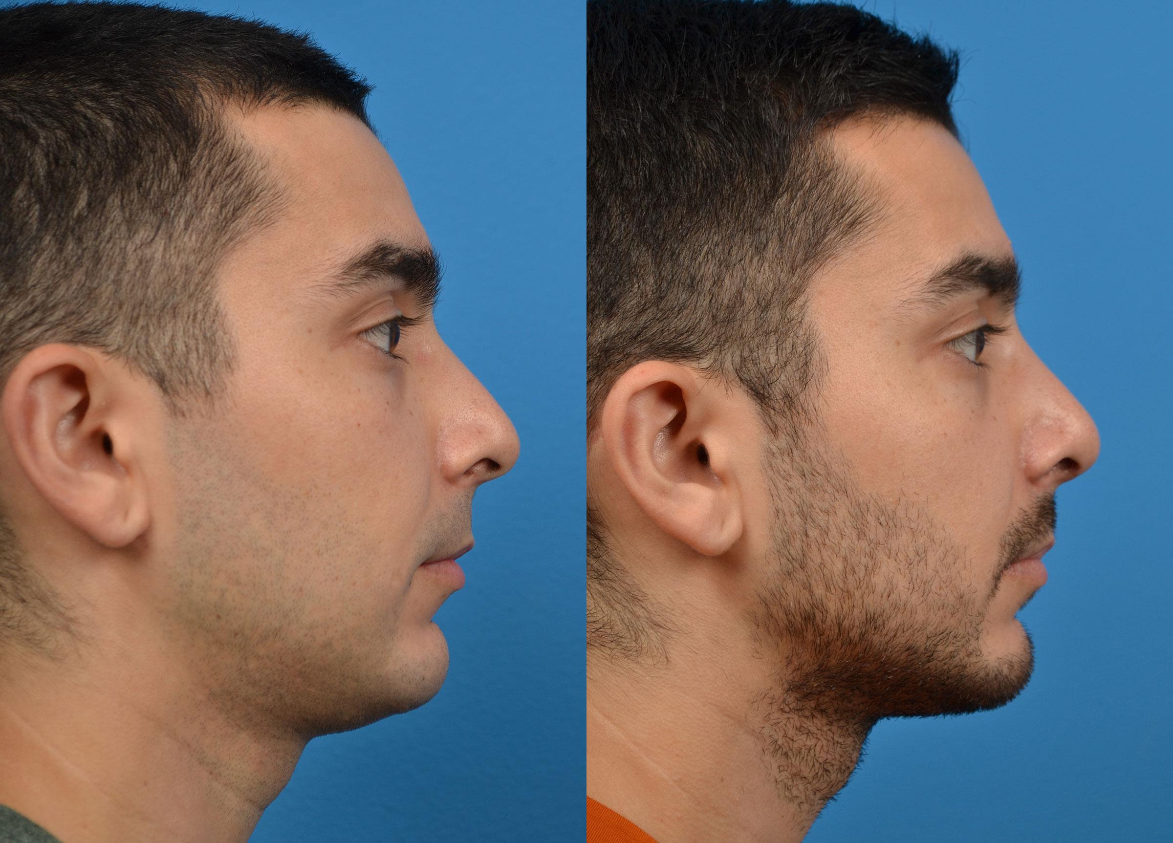 Rhinoplasty Before & After Gallery - Patient 122406921 - Image 3