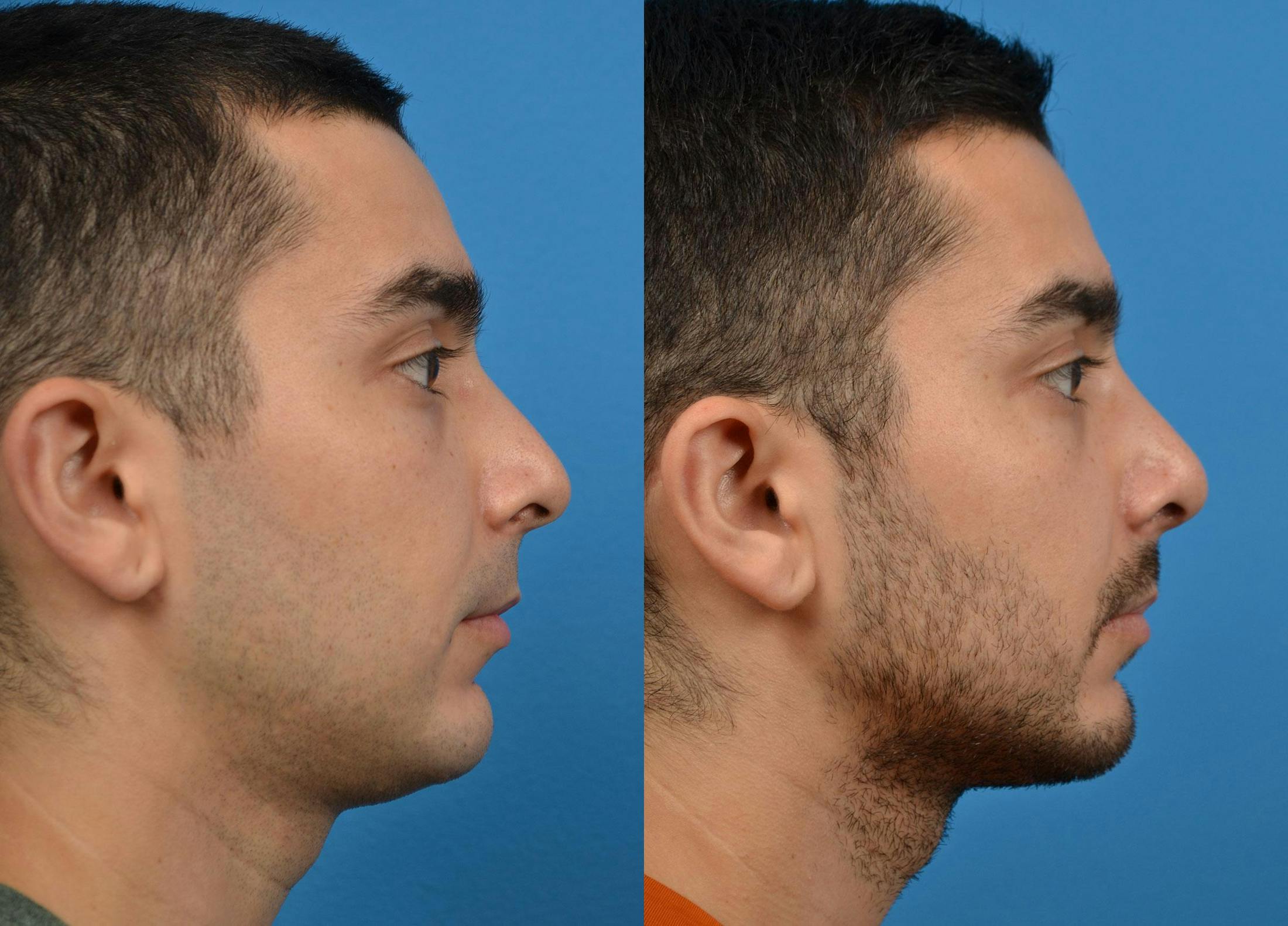 Rhinoplasty Before & After Gallery - Patient 122406921 - Image 3
