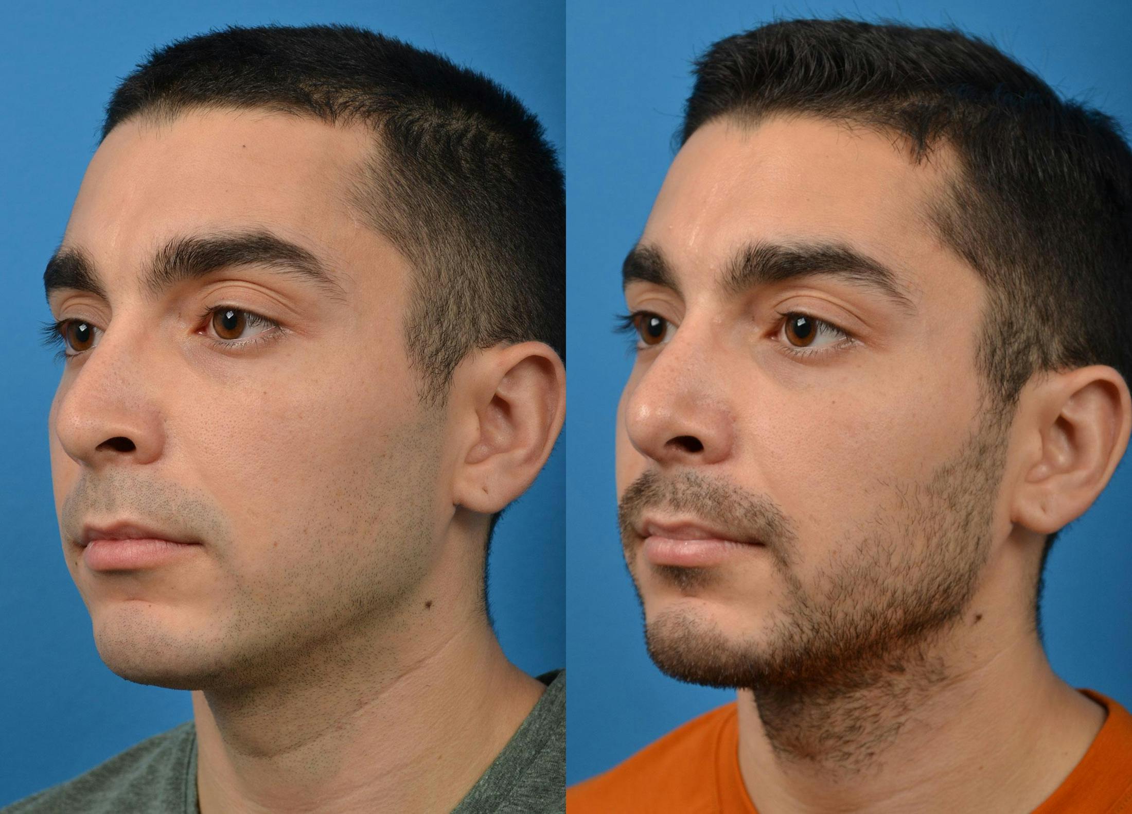 Rhinoplasty Before & After Gallery - Patient 122406921 - Image 4