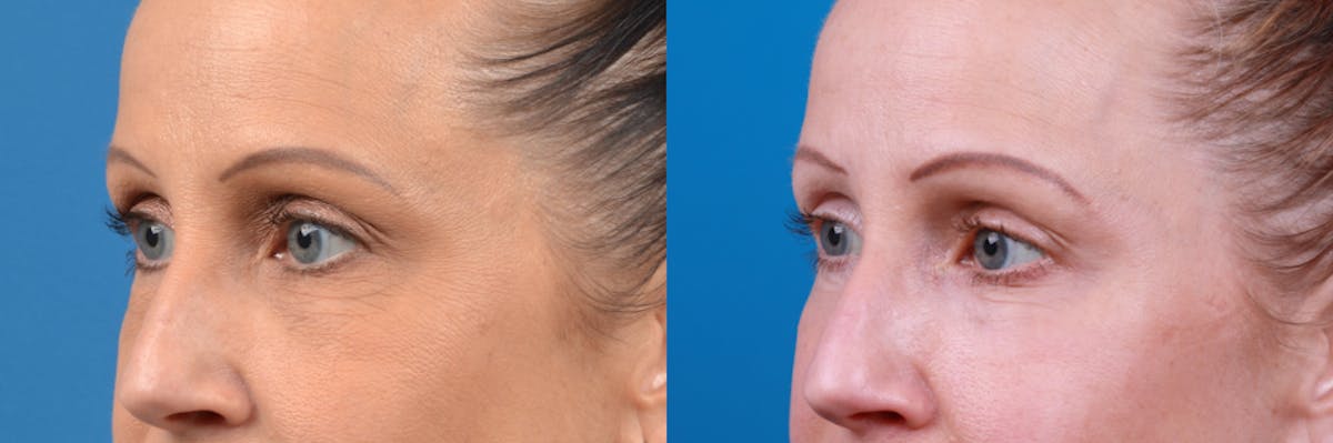 Skin Resurfacing Before & After Gallery - Patient 122406922 - Image 1