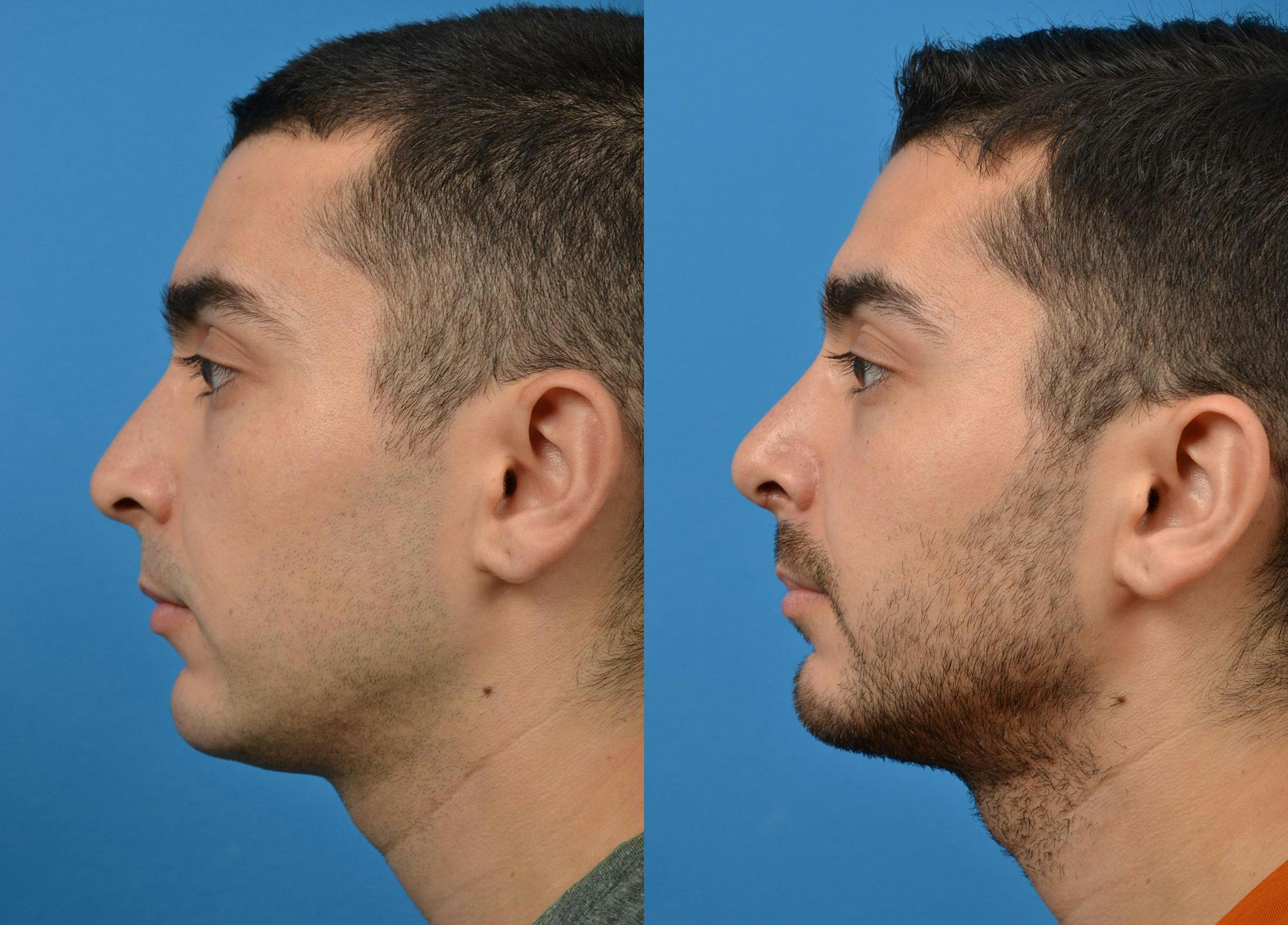 Rhinoplasty Before & After Gallery - Patient 122406921 - Image 5