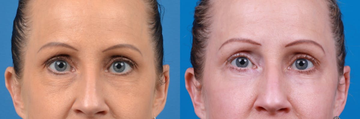Skin Resurfacing Before & After Gallery - Patient 122406922 - Image 2