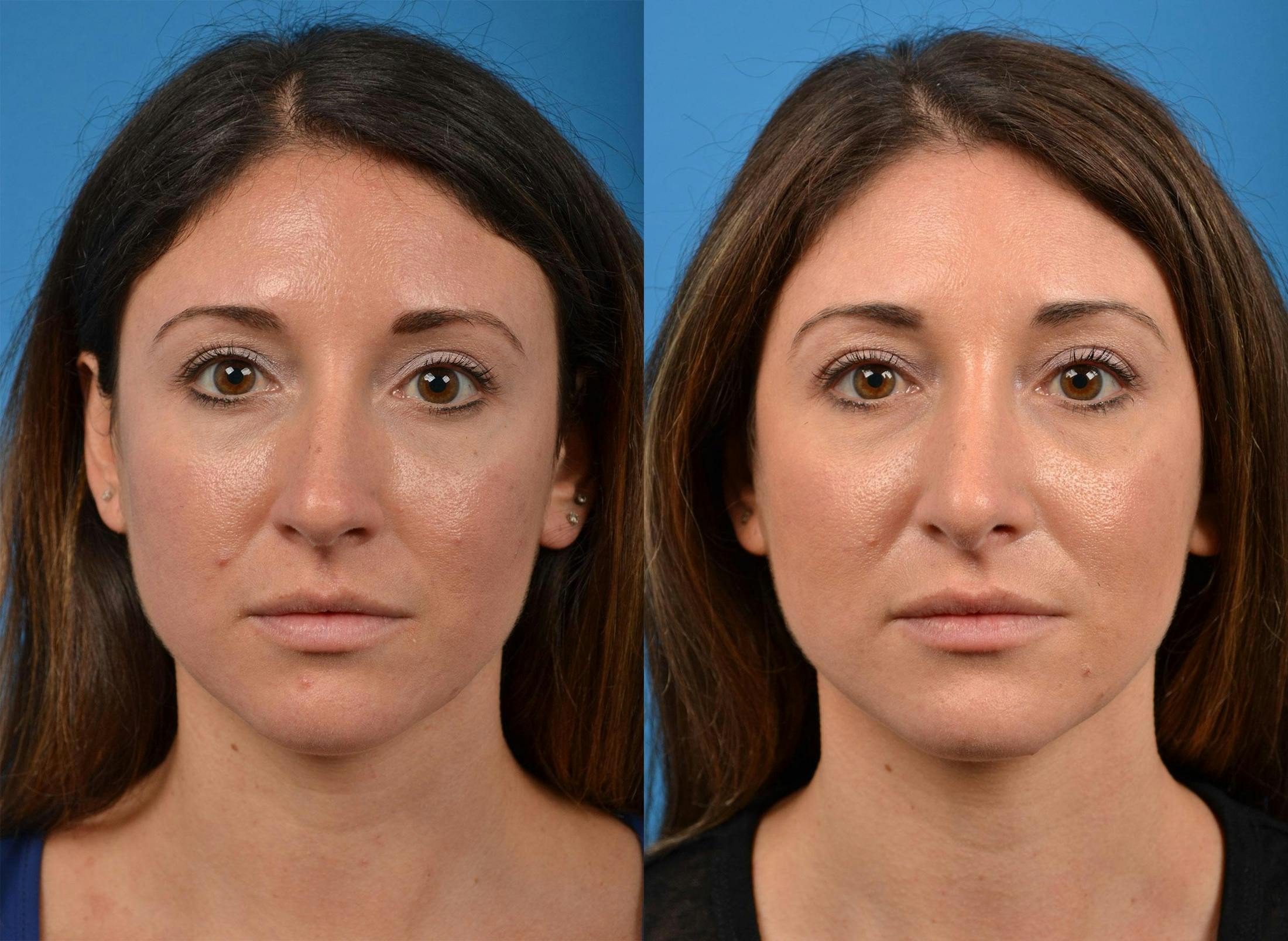 Rhinoplasty Before & After Gallery - Patient 122406926 - Image 1