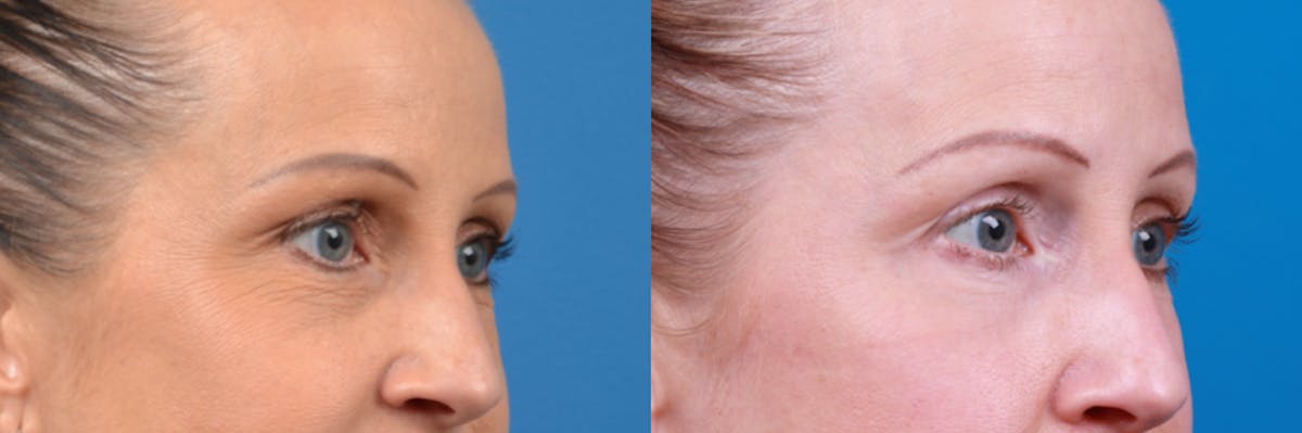 Skin Resurfacing Before & After Gallery - Patient 122406922 - Image 3