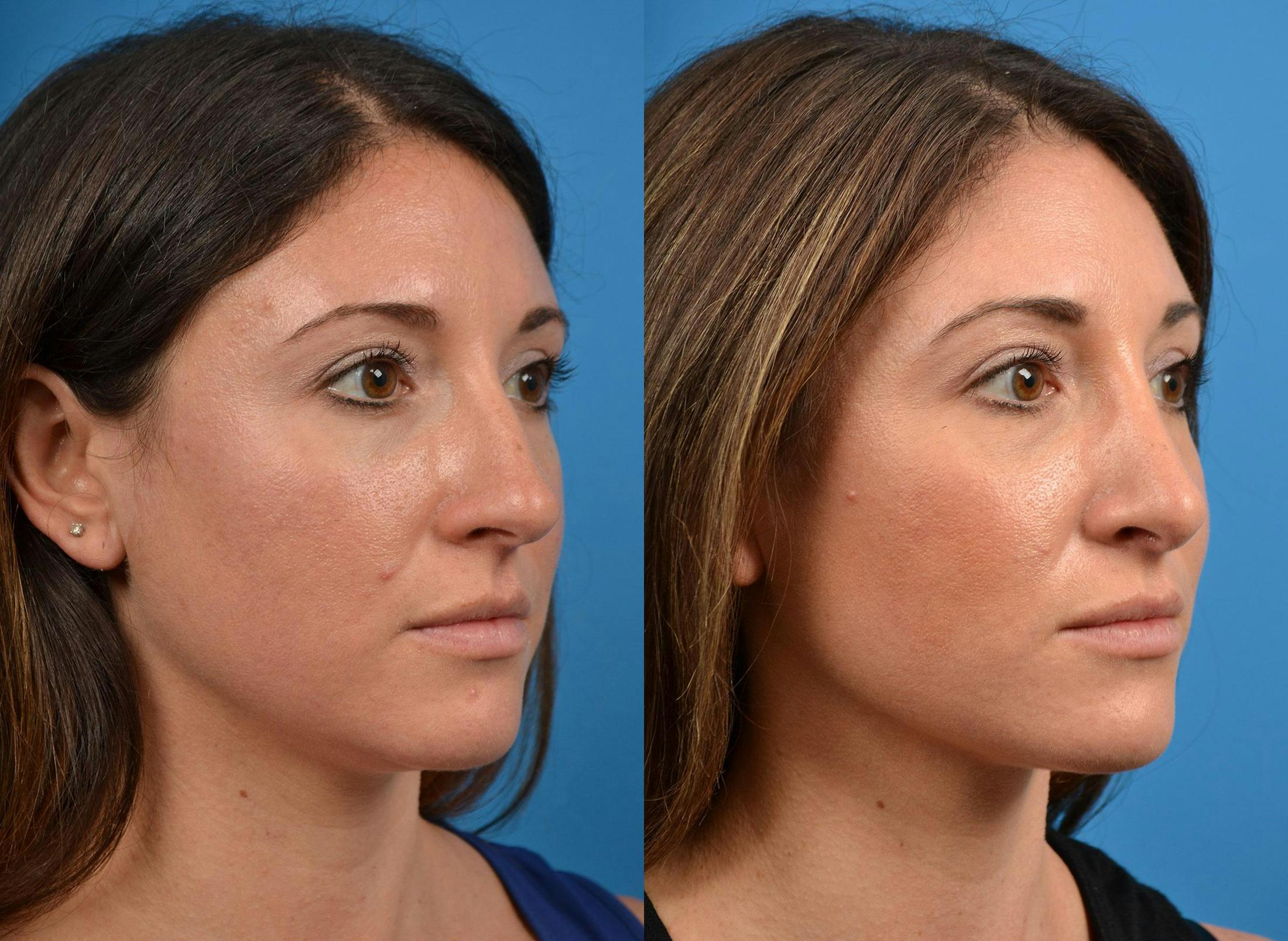 Rhinoplasty Before & After Gallery - Patient 122406926 - Image 2