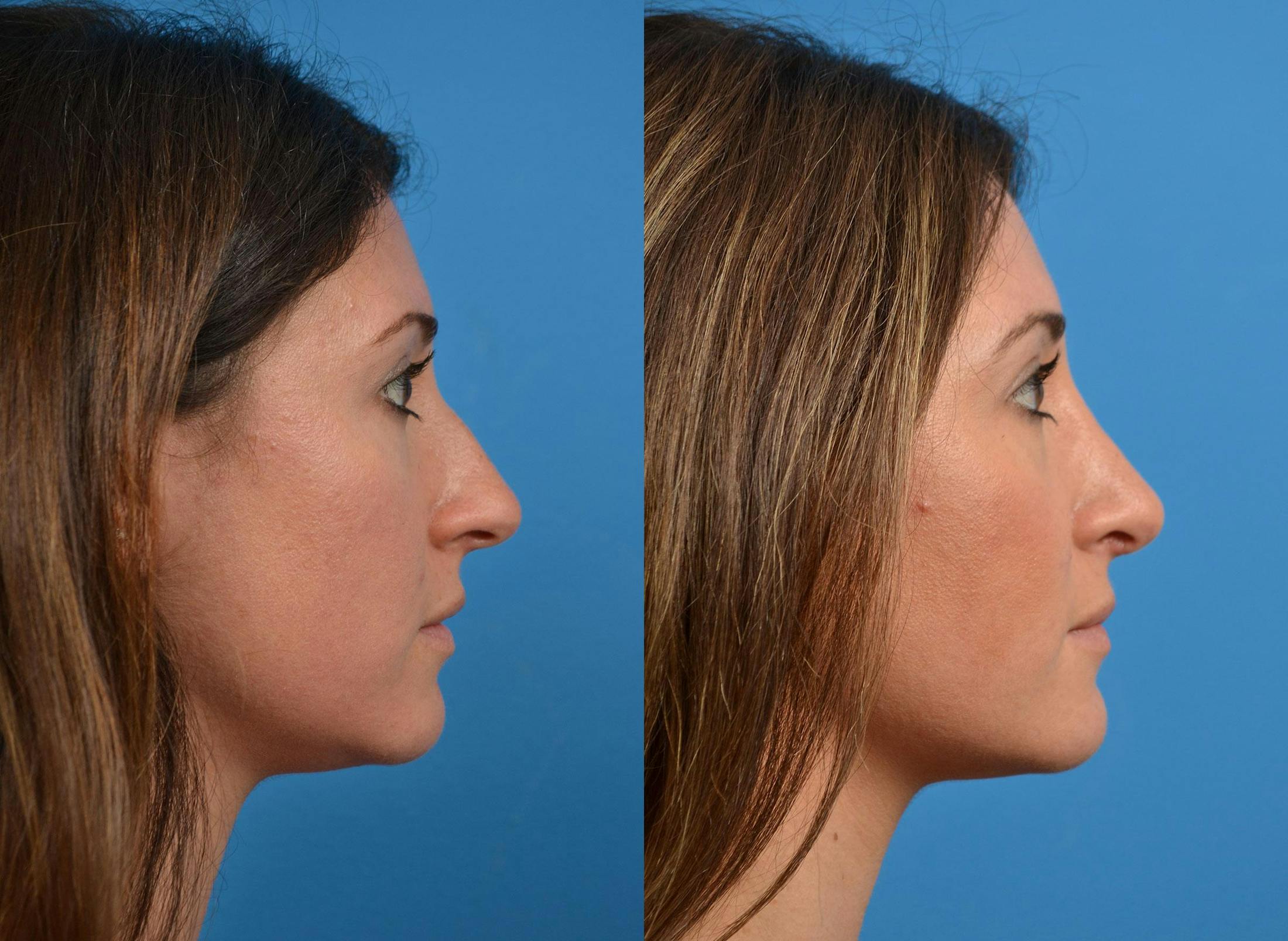 Rhinoplasty Before & After Gallery - Patient 122406926 - Image 3