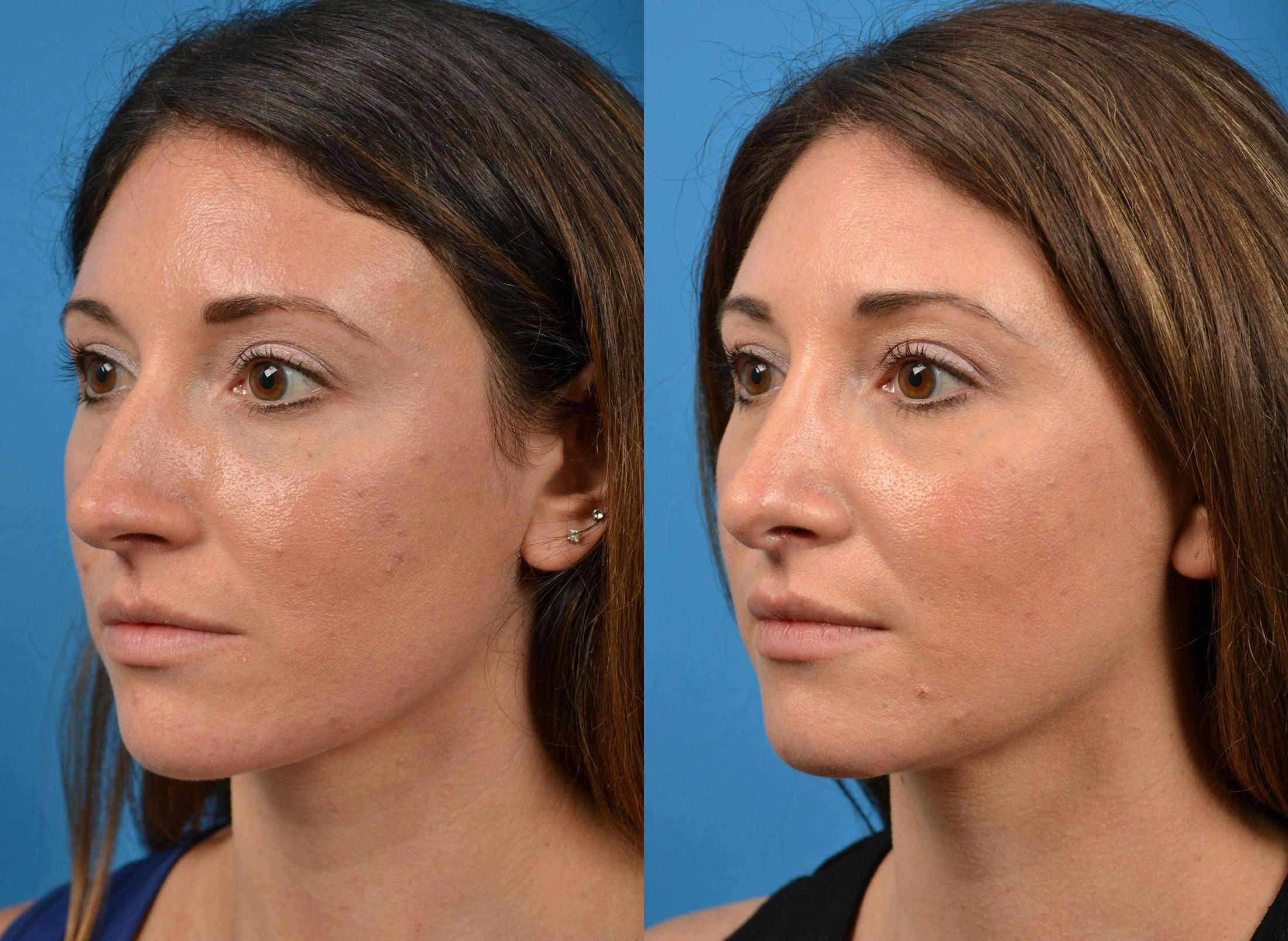 Rhinoplasty Before & After Gallery - Patient 122406926 - Image 4