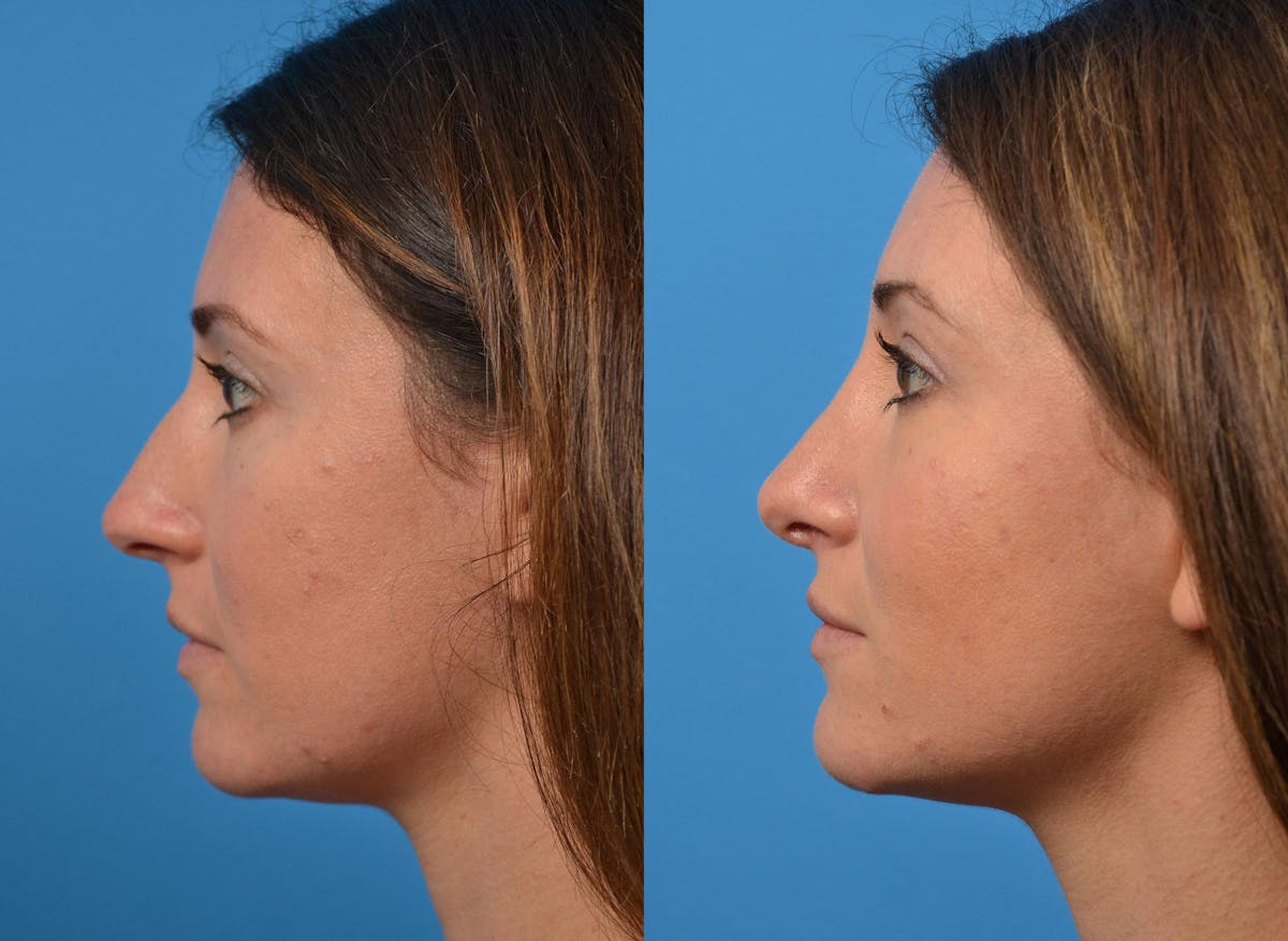 Rhinoplasty Before & After Gallery - Patient 122406926 - Image 5