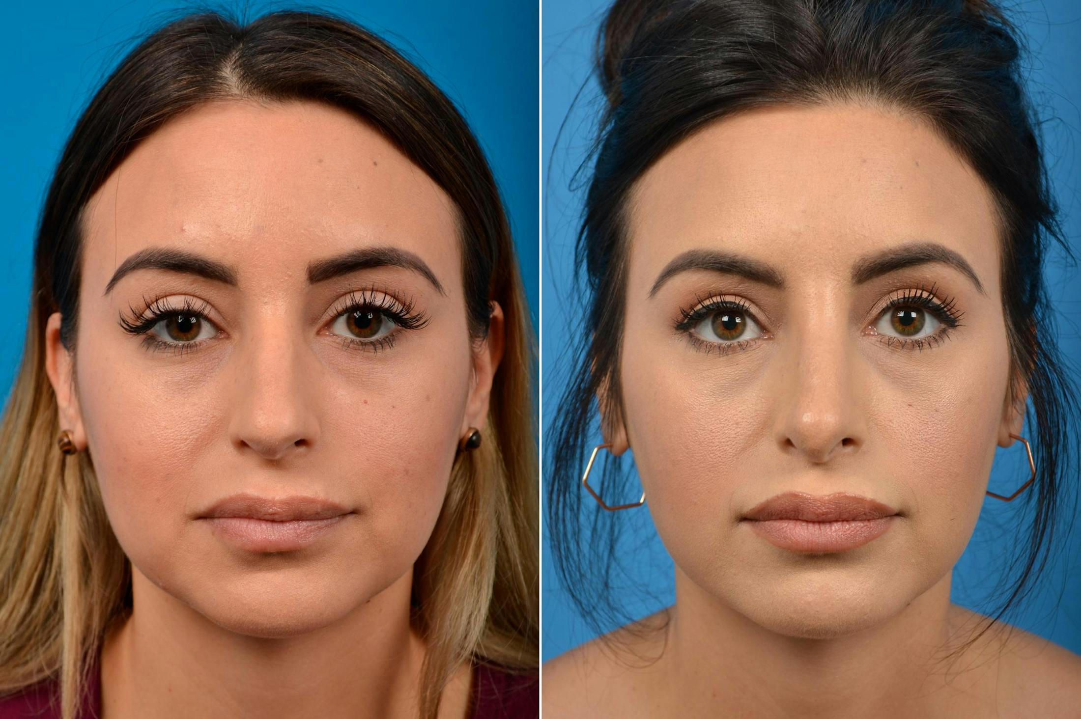 Rhinoplasty Before & After Gallery - Patient 122406929 - Image 1