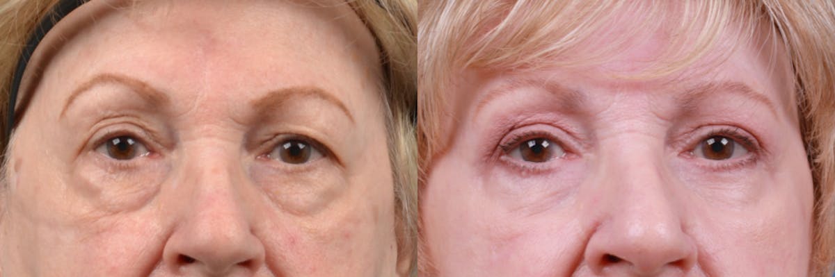 Skin Resurfacing Before & After Gallery - Patient 122406927 - Image 2