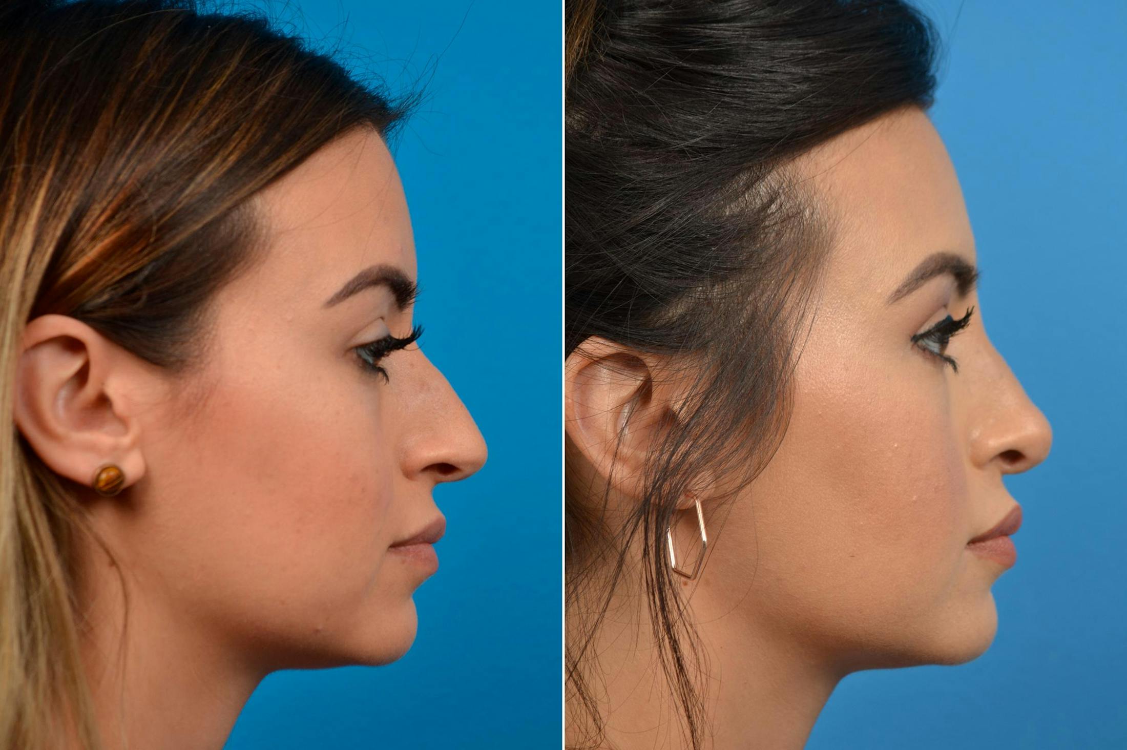 Rhinoplasty Before & After Gallery - Patient 122406929 - Image 2